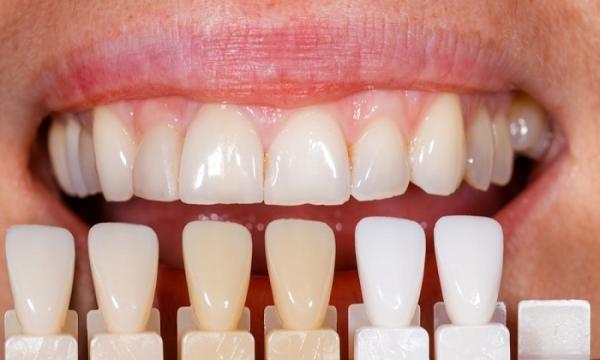 فرمول غذایی برای سفید کردن دندان ها